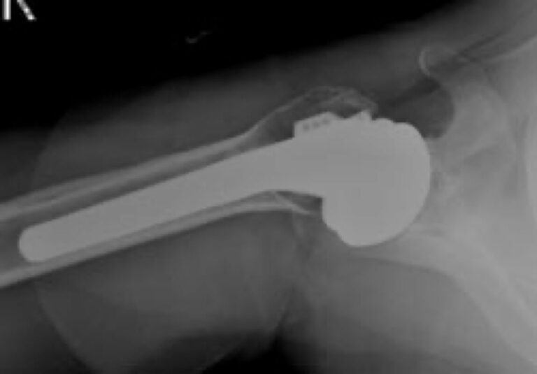 DePuy - Standard - Anatomic<br><span>Click image to see a larger version.</span>