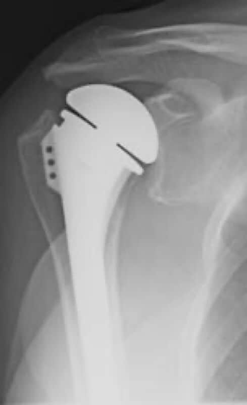 DePuy - Standard - Anatomic<br><span>Click image to see a larger version.</span>