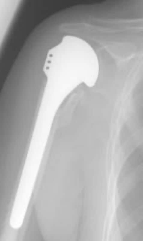 DePuy - Standard - Anatomic<br><span>Click image to see a larger version.</span>