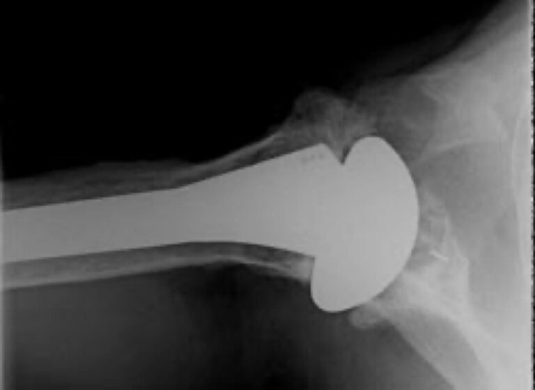 DePuy - Standard - Anatomic<br><span>Click image to see a larger version.</span>