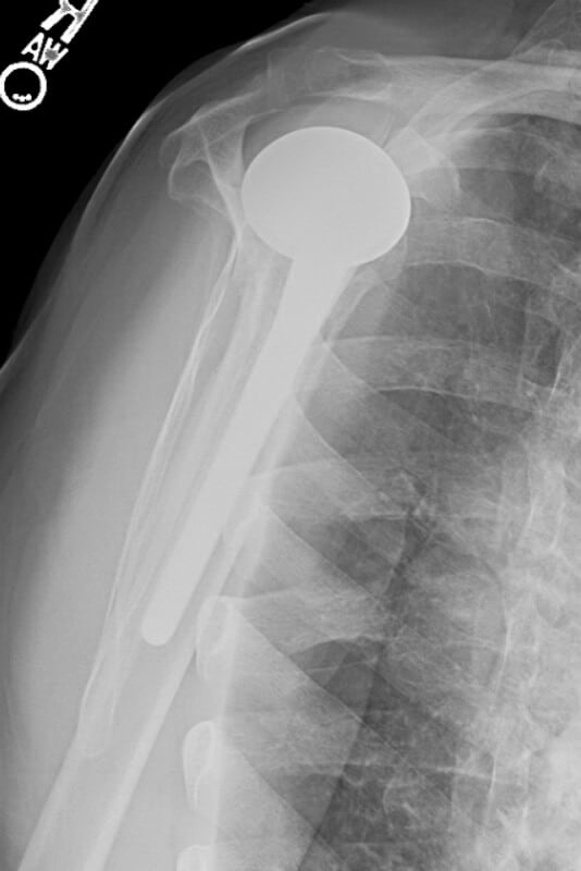 DePuy - Standard - Anatomic<br><span>Click image to see a larger version.</span>