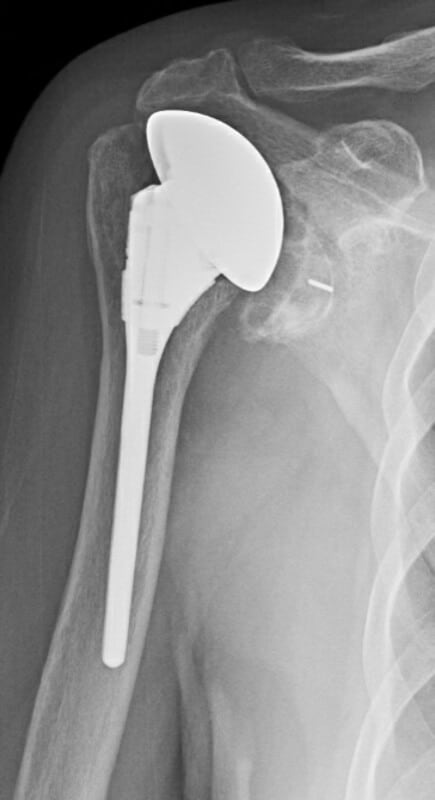 DePuy - Standard - Anatomic<br><span>Click image to see a larger version.</span>