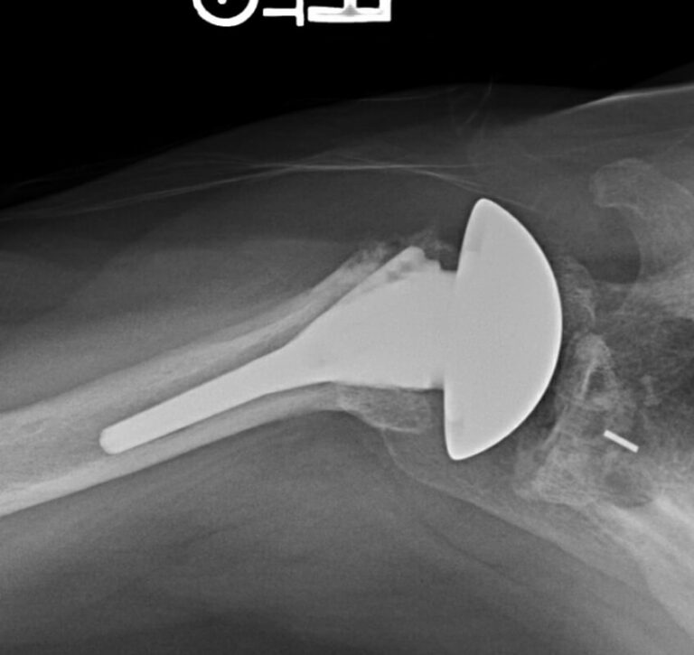 DePuy - Standard - Anatomic<br><span>Click image to see a larger version.</span>