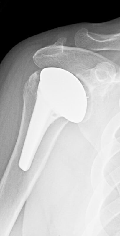 DePuy - Short - Anatomic<br><span>Click image to see a larger version.</span>