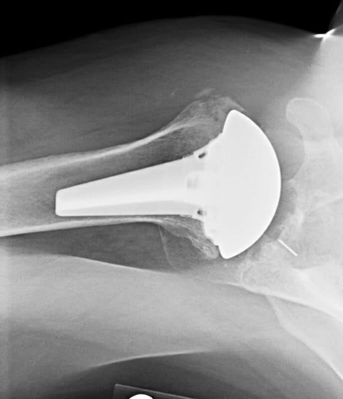 DePuy - Short - Anatomic<br><span>Click image to see a larger version.</span>