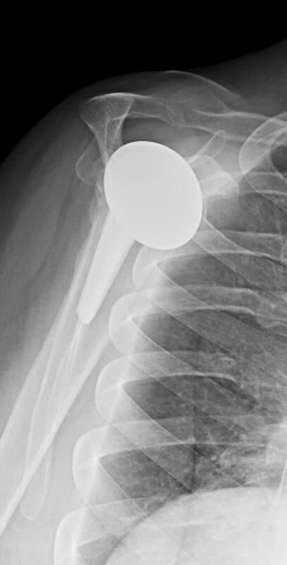 DePuy - Short - Anatomic<br><span>Click image to see a larger version.</span>