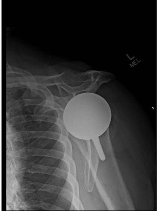 Shoulder Innovations - Short - Anatomic<br><span>Click image to see a larger version.</span>