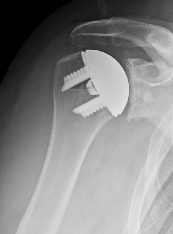 DePuy - Stemless - Anatomic<br><span>Click image to see a larger version.</span>
