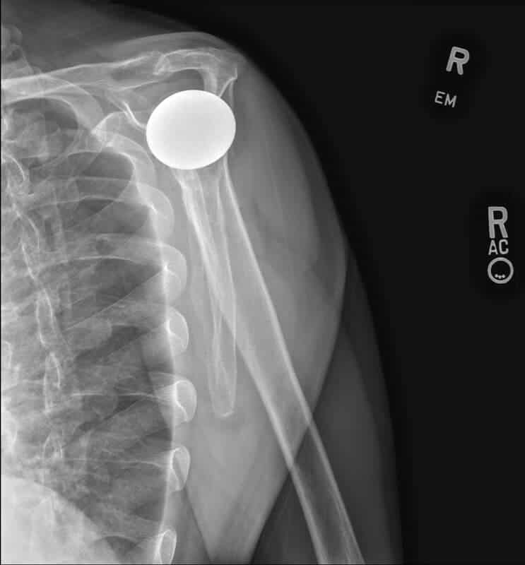 Stryker/Wright/Tornier - Stemless - Anatomic<br><span>Click image to see a larger version.</span>