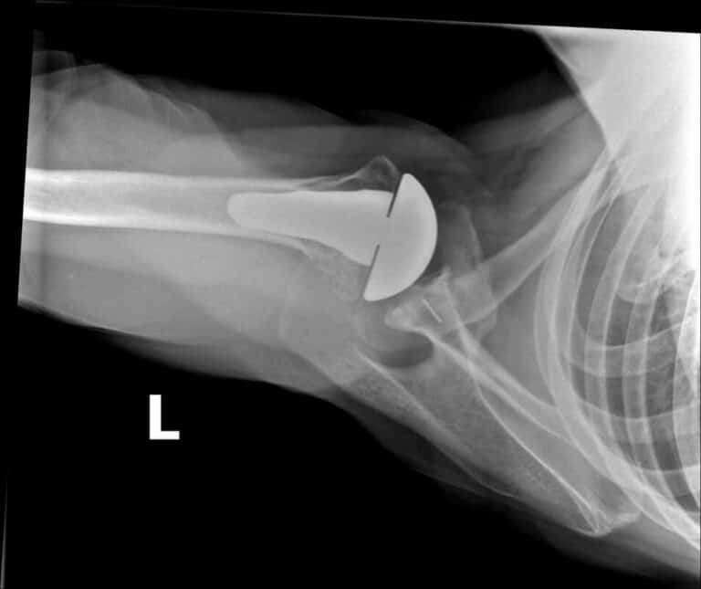 Stryker/Wright/Tornier - Short - Anatomic<br><span>Click image to see a larger version.</span>