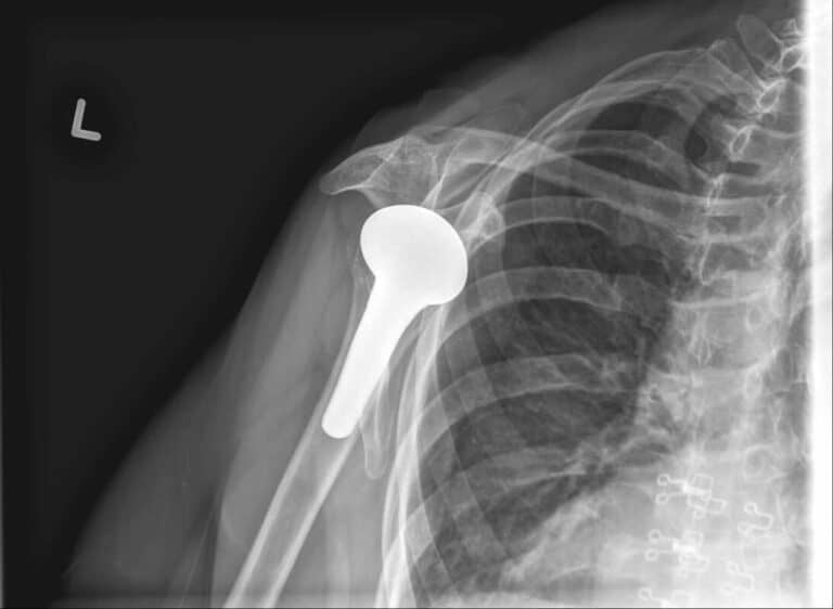 Stryker/Wright/Tornier - Short - Anatomic<br><span>Click image to see a larger version.</span>